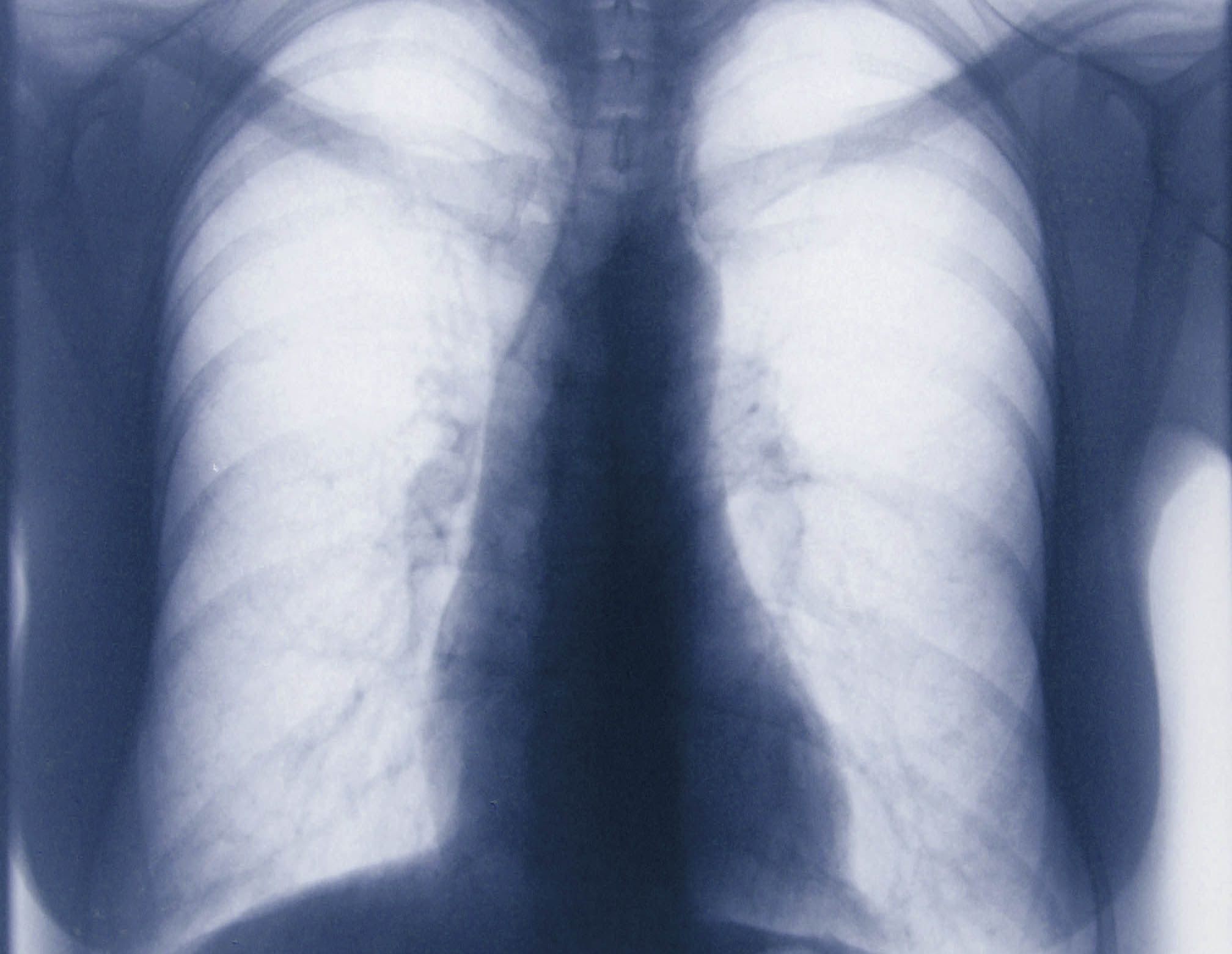Chronische Bronchitis Röntgenbild – QKAVL